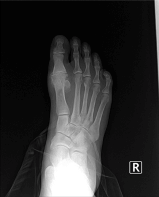 Surgery For Arthritis Of The Foot  in the Issaquah, WA 98027 area