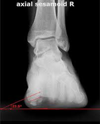 Picture of Bunion