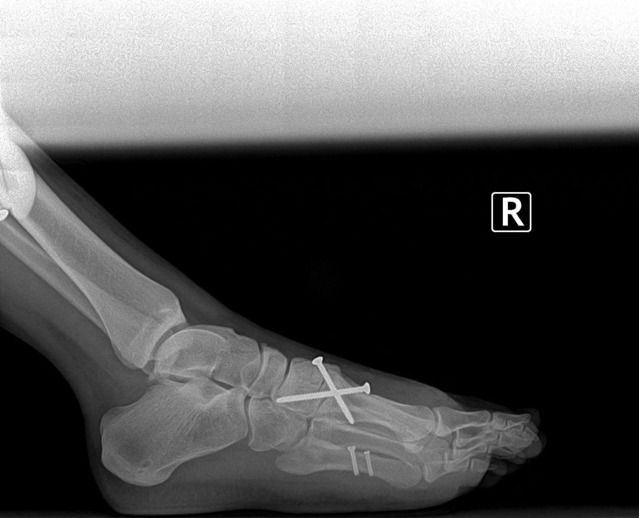 Bunion and tailor's bunion surgery, preoperative and postoperative x rays