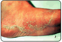 Tinea Pedis or Athelete's Foot treathment in the Issaquah, WA 98027 area