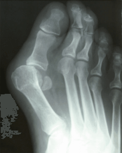 Bunion x-ray