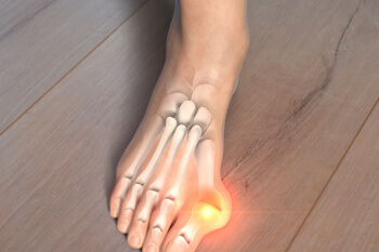 Bunions x ray caucasian foot ssR