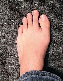 Morton's foot type