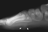 fibromatosis