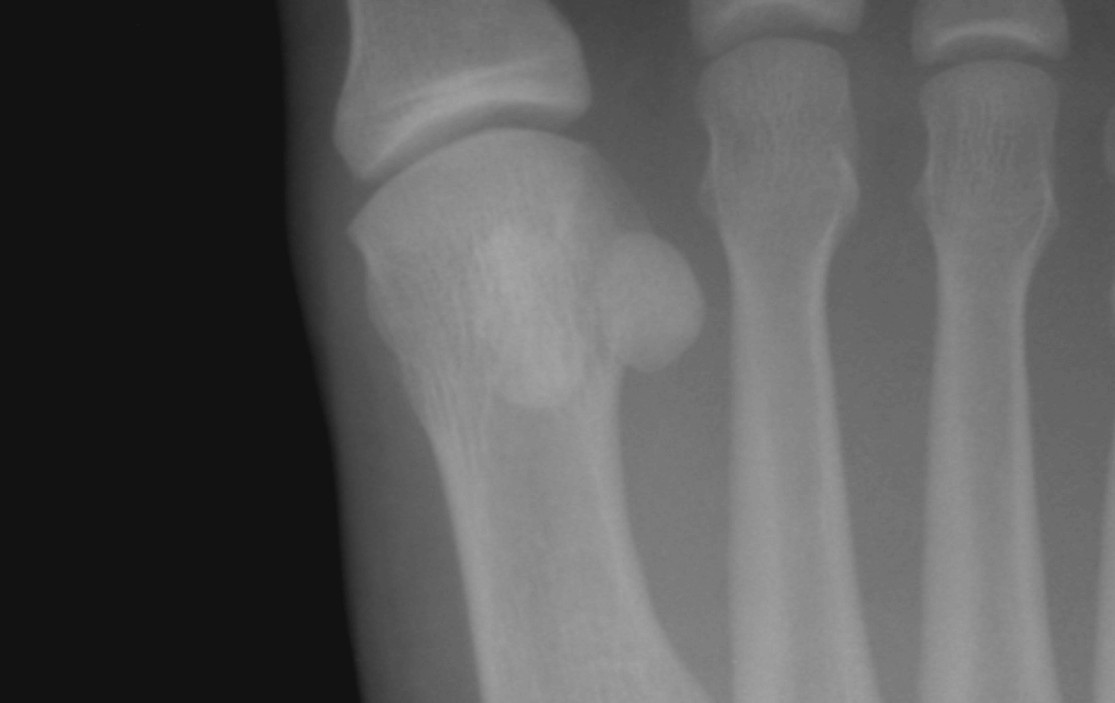 Sesamoid Bone