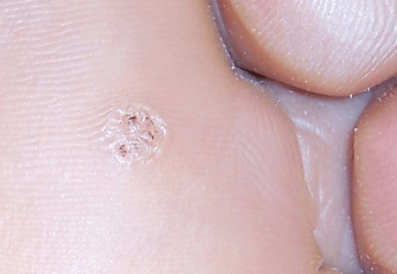 Plantar Wart - Wikipedia