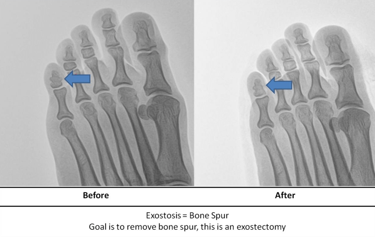 Bone Spurs, Pressure Points Your Toes