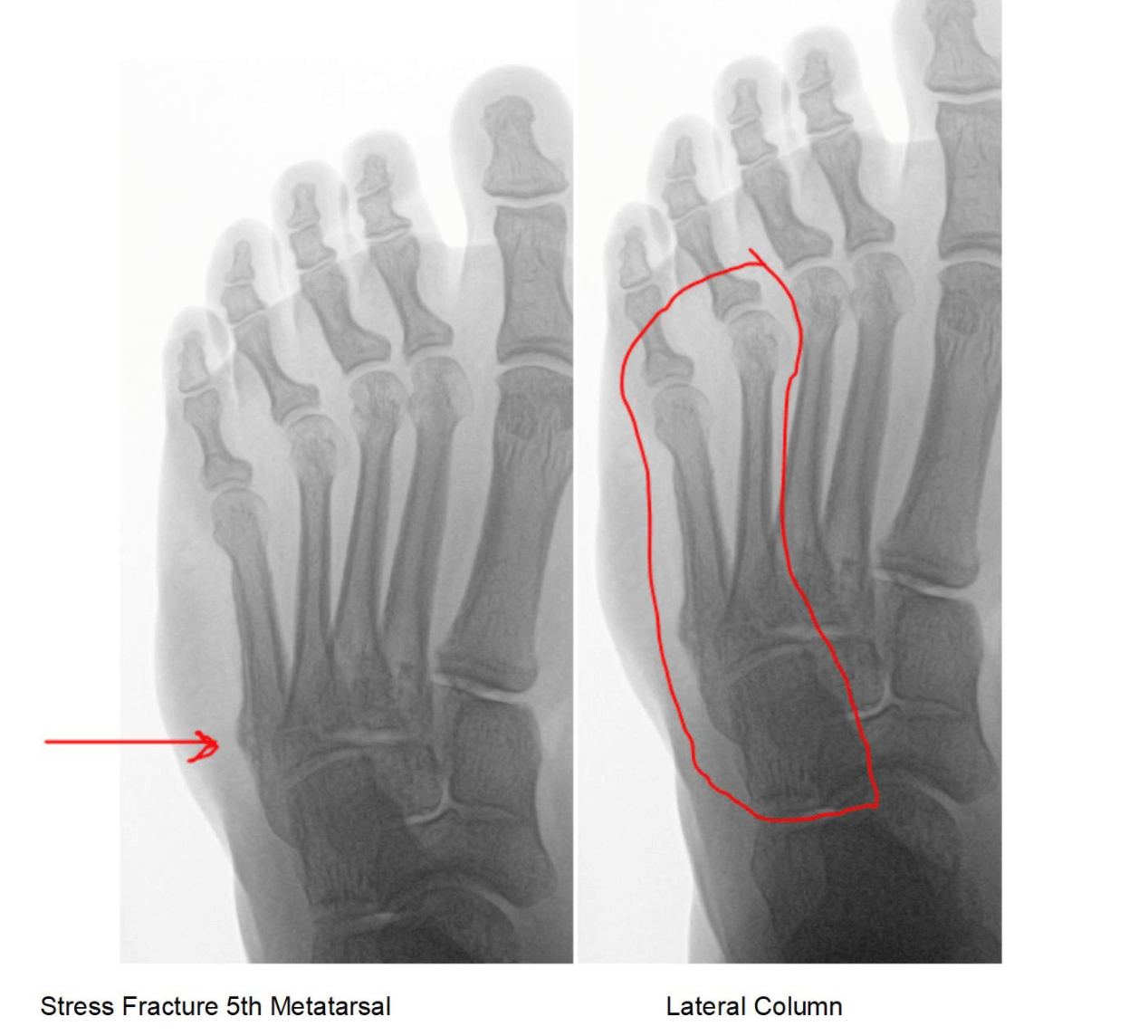 Dr. Young Talks About Lateral Column Pain and Lateral Overload