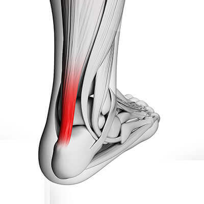 achilles tendonitis pain