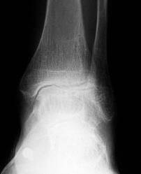 Ankle arthritis treatment in the Issaquah, WA 98027 area