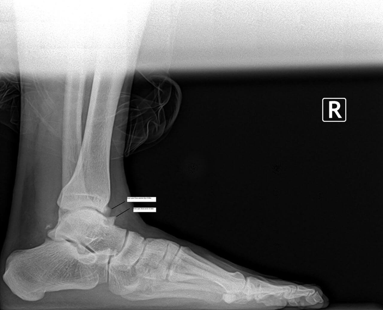 What is Ankle Bone Spur? Symptoms, Causes, Diagnosis & Physiotherapy  Treatment of Ankle Bone Spur...