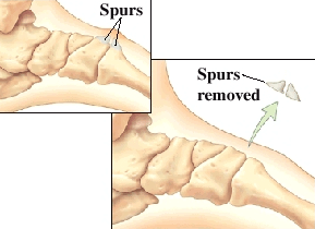 Dorsal spurring deals foot