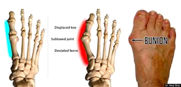 Picture of Bunion
