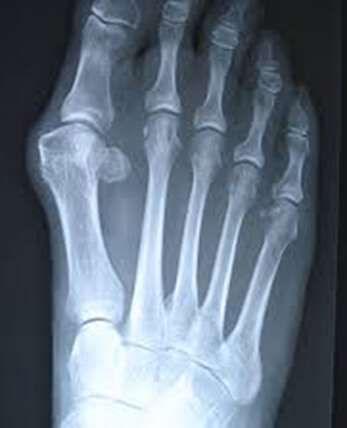 Picture of Bunion