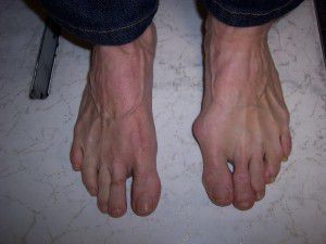 Bunions can prove painful, get bunion treatments from the Washington Bunion Center