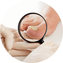 Fungal Toenails Diagnosis and Treatment in Issaquah, WA 98027