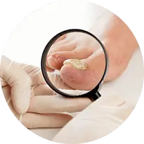 Fungal Toenails Diagnosis and Treatment in Issaquah, WA 98027