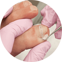 Ingrown Toenail - Edmonds Medical Clinic