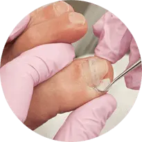 Ingrown Toenails Diagnosis & Treatment in the Issaquah, WA 98027