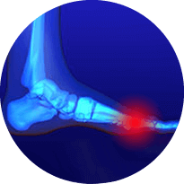 Morton's Neuroma - Causes, Symptoms, Diagnosis & Treatment in Issaquah, WA 98027