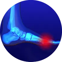 Morton's Neuroma - Causes, Symptoms, Diagnosis & Treatment in Issaquah, WA 98027