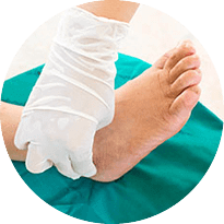 Peripheral neuropathy in the foot - treatment and care in Issaquah, WA 98027