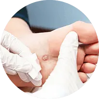 Foot Wart Treatment in the Issaquah, WA 98027