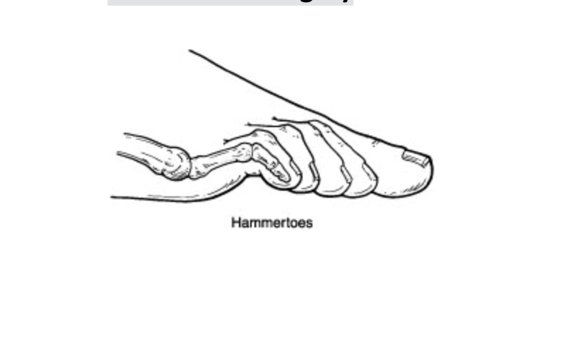 hammertoe