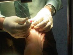 ingrownnailsurgery1