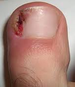 before picture ingrown nail