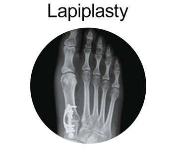 lapiplasty