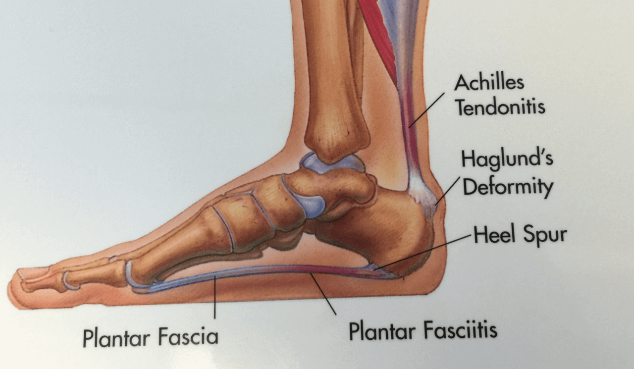 Plantar Fasciitis — Dan Buglio - Your Pain Free Coach & TMS Expert