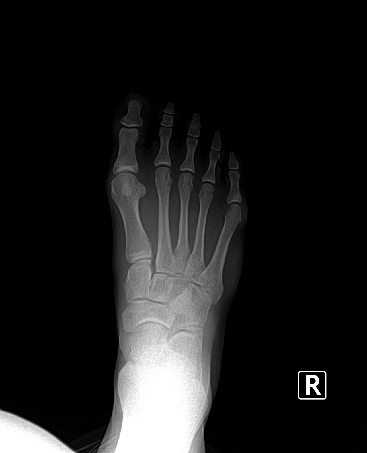 Preoperateive x ray of the bunion and tailor's bunion.