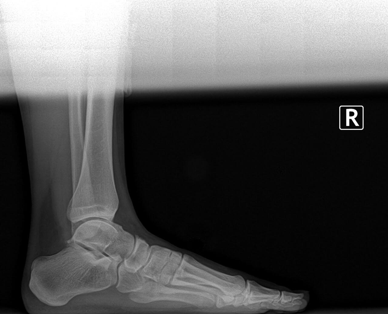 preoperative bunion and tailor's bunion