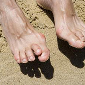 Issaquah Podiatrist's Special Services - Hammertoes Treatment