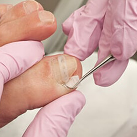Issaquah Podiatrist's Special Services - Ingrown Toenails Treatment