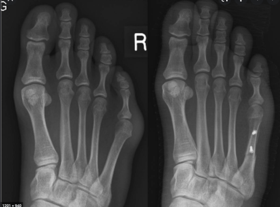 Dr Brandon Nelson, A Board Certified Physician & Surgeon, Finds the Lapiplasty Surgical Procedure for Bunions to be Highly Successful