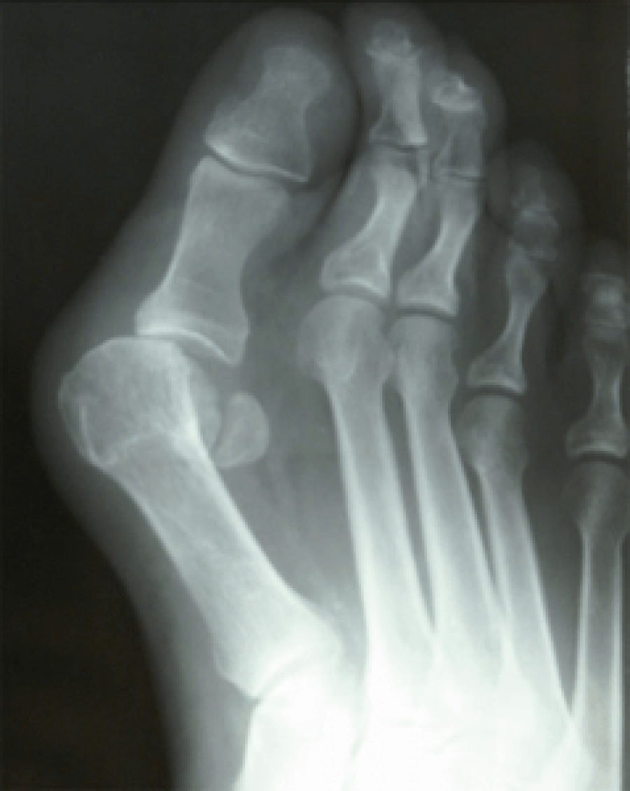 Dr Timothy Young Discusses Bunion Surgeries 