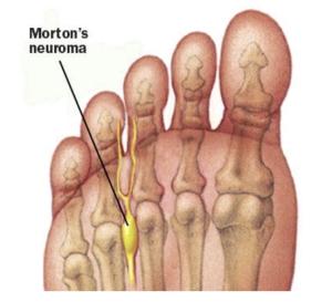 Dr. Timothy Young, a Board-Certified Foot Surgeon, Discusses Neuroma Treatments