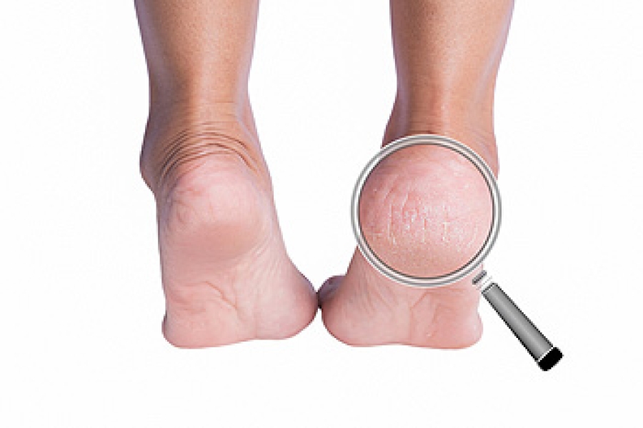 Medical Causes of Cracked Heels