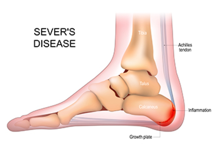 Symptoms and Effective Treatment for Sever’s Disease