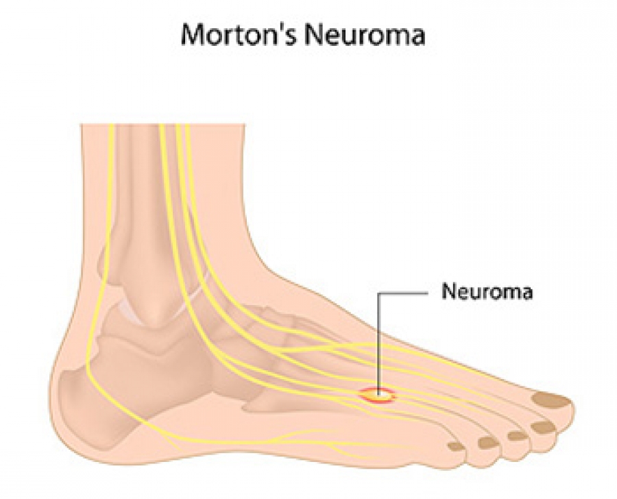 Dr. Brandon Nelson, A Board Certified Surgeon, Discusses Neuroma Surgery