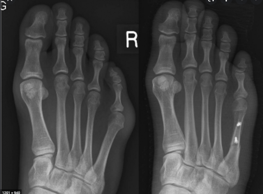 Dr. Timothy Young, Board Certified Foot Surgeon Discusses a More Involved Tailor's Bunion Surgery Correction
