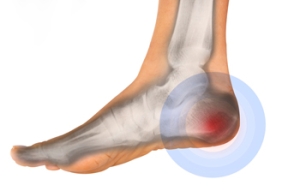 What Causes Heel Bursitis?