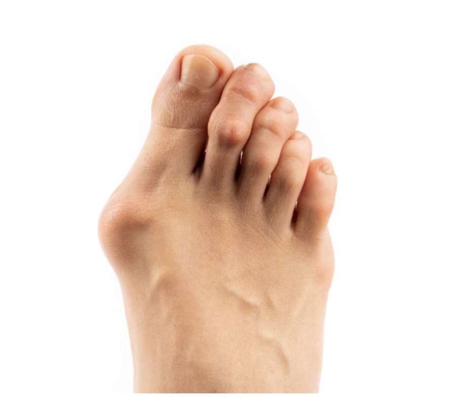 Dr Timothy Young, a Board Certified Foot Surgeon on: Should I Get Bunion Surgery?