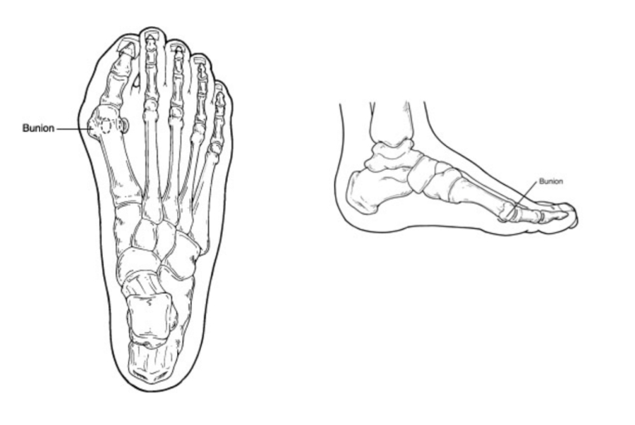Dr Brandon Nelson, A Double Board Certified Physician and Surgeon, Discusses Bunion Surgery Questions