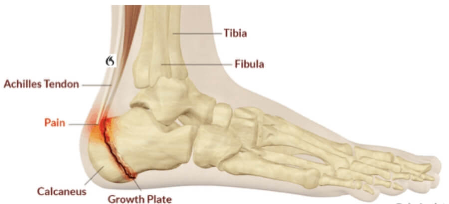 Dr. Timothy Young, a Board-Certified Foot Surgeon Discusses Achilles Tendon Problems in Children