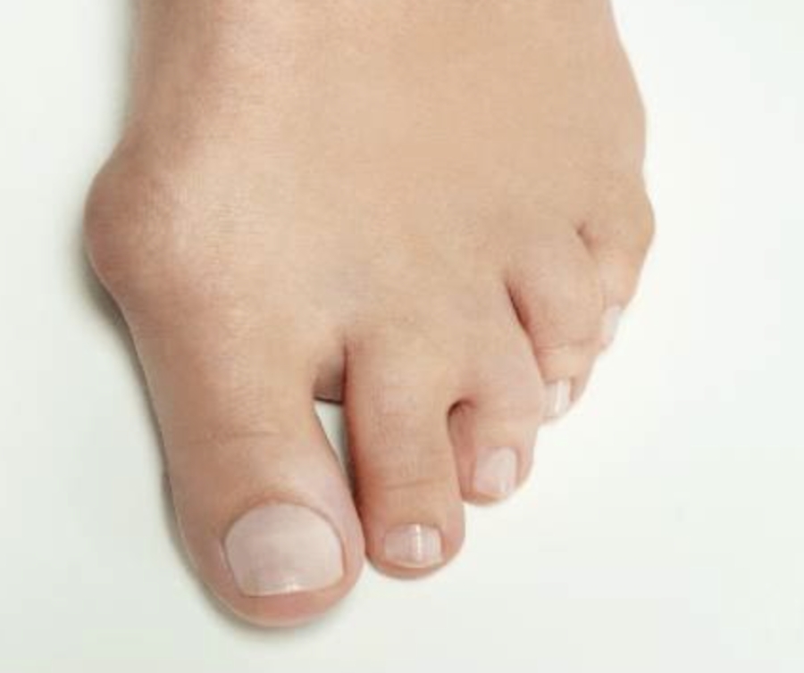 Dr Timothy Young, a board certified foot surgeon talks about Reversing a Bunion: Understanding the Causes, Treatment Options, and Prevention Part 2