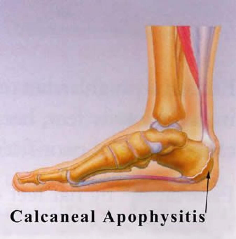 Apophysitis (Sever's Disease), A Cause Of Heel Pain In Children