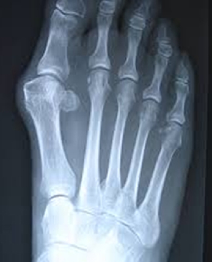 Dr Brandon Nelson, A Board-Certified Physician & Surgeon Discusses Bunion Pain